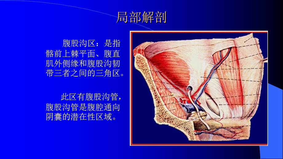 腹腔镜疝修补术(护理查房)ppt课件.ppt_第2页