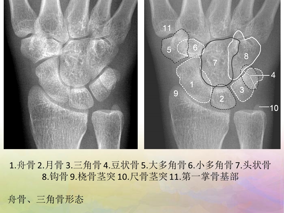 腕关节 解剖ppt课件.ppt_第3页