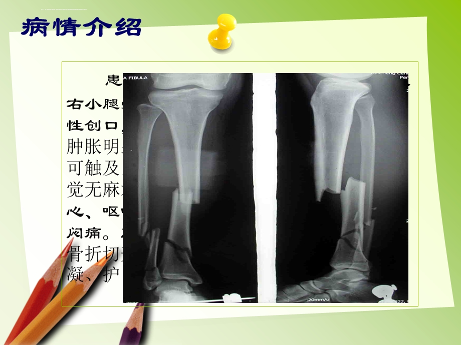 胫腓骨骨折的护理 ppt课件.ppt_第2页