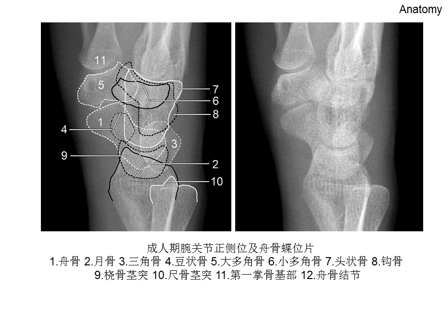 腕关节 X线解剖ppt课件.ppt_第3页