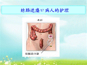 结肠造瘘口病人的护理ppt课件.ppt