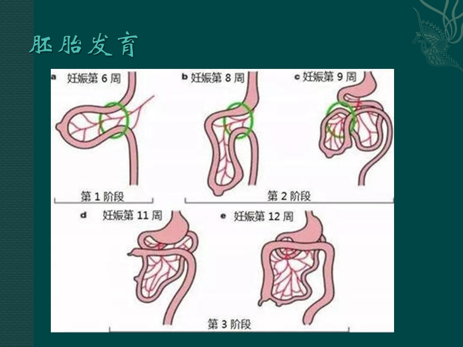 肠旋转不良ppt课件.pptx_第2页