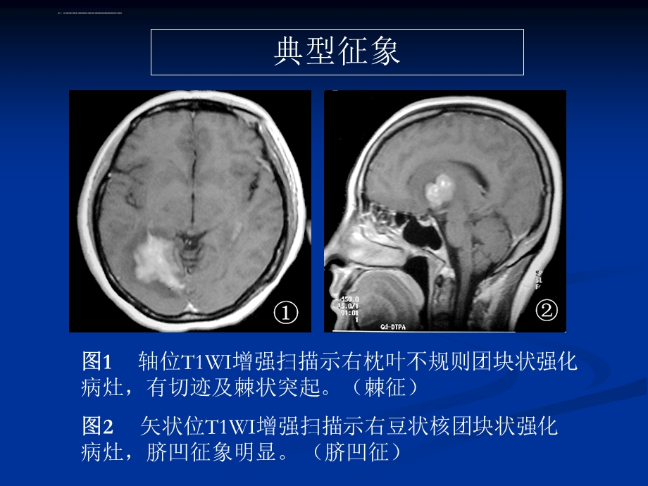 脑部原发性淋巴瘤的MRI诊断ppt课件.ppt_第3页