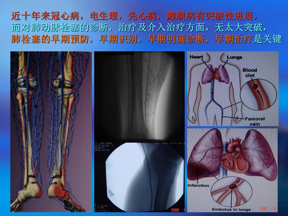 肺栓塞的诊断及介入治疗ppt课件.ppt_第2页