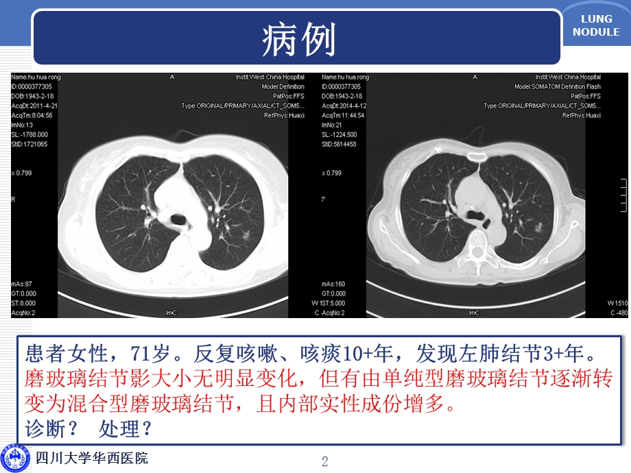 肺磨玻璃结节的诊断与临床处理策略ppt课件.ppt_第2页