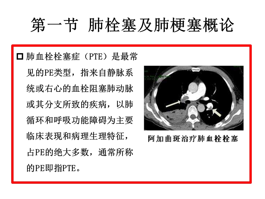 肺栓塞及肺梗塞CT诊断ppt课件.pptx_第3页