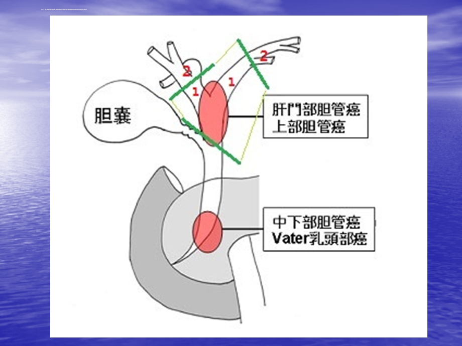 肝门部胆管癌模板ppt课件.ppt_第3页