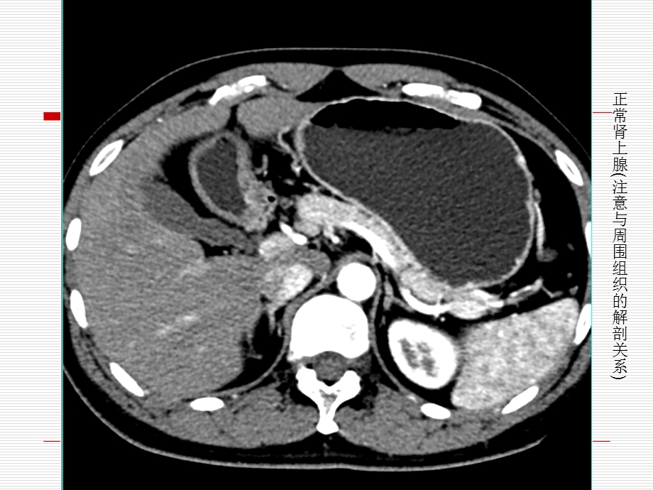 肾上腺病变的CT诊断ppt课件.ppt_第3页