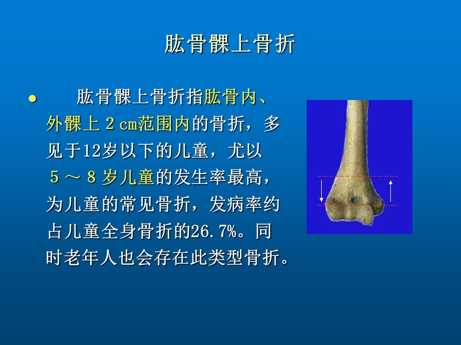 认识肱骨髁上骨折ppt课件.ppt_第2页