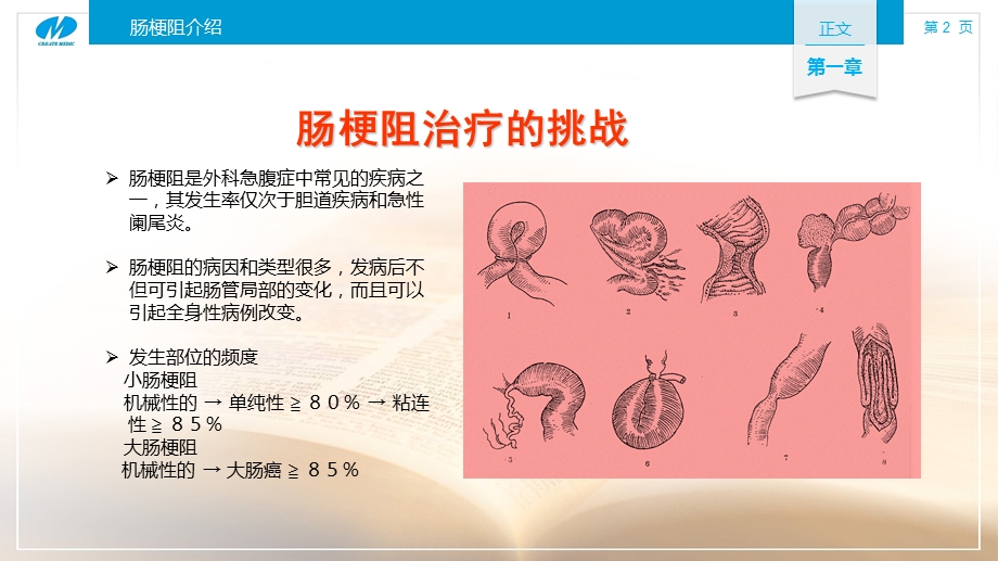 肠梗阻导管的临床应用及护理ppt课件.ppt_第2页