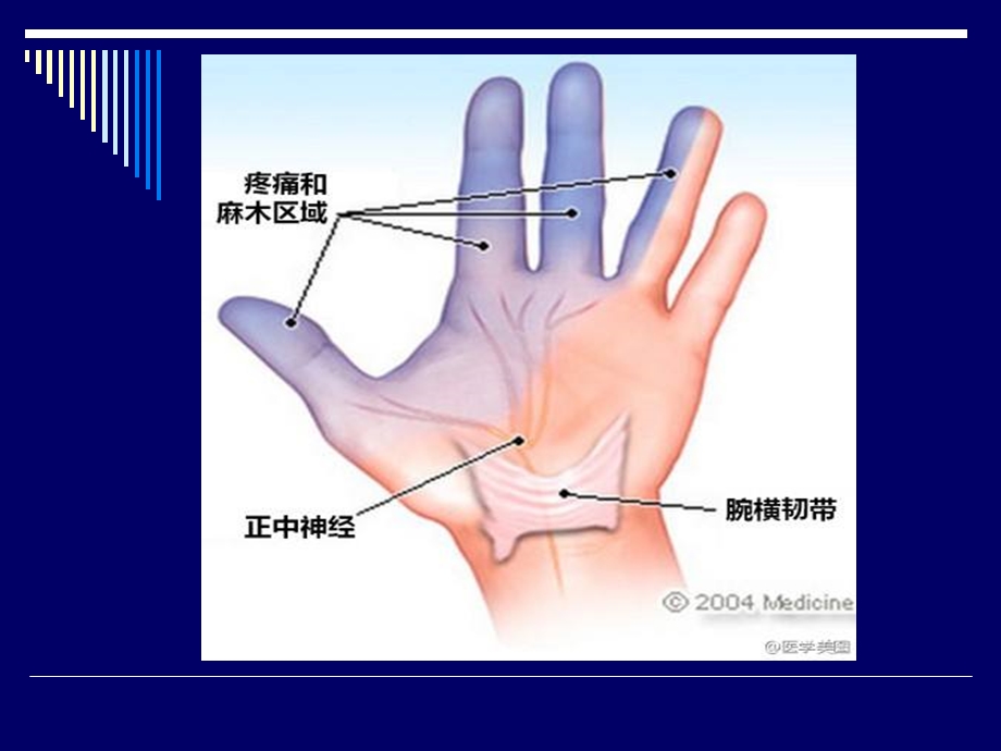 超声引导下治疗腕管综合症ppt课件.ppt_第3页