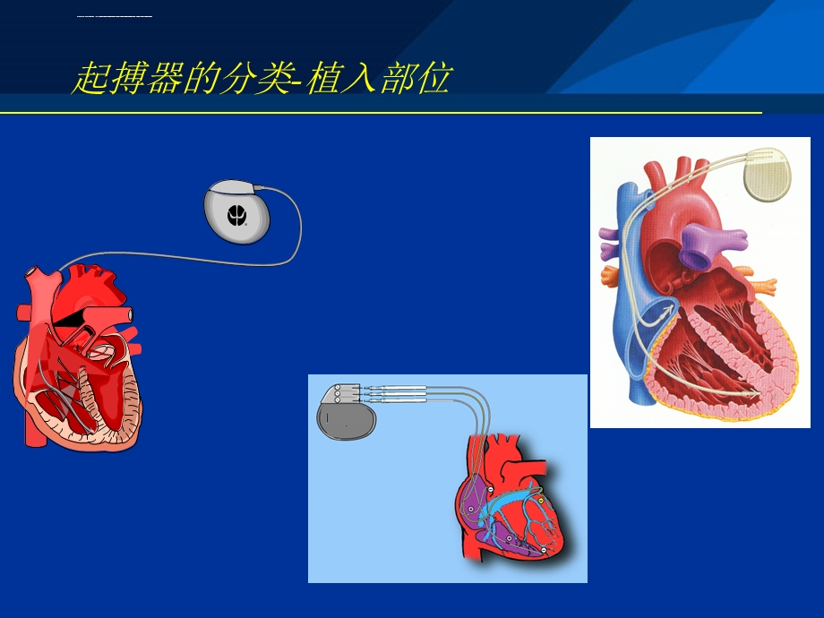 起搏器基础理论导线单极双极欧姆定律起搏与感知ppt课件.ppt_第2页