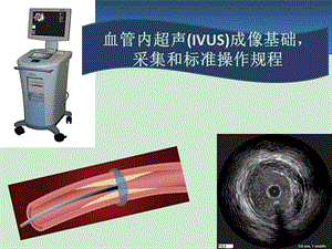 血管内超声IVUS简介ppt课件.ppt