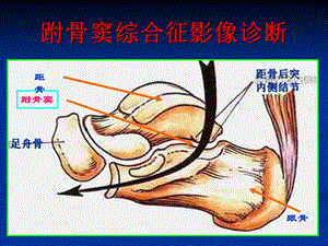 跗骨窦综合征影像诊断ppt课件.ppt