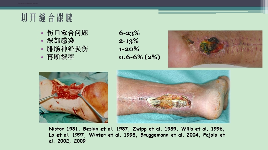 跟腱断裂修复存在的问题及解决新策略ppt课件.ppt_第3页