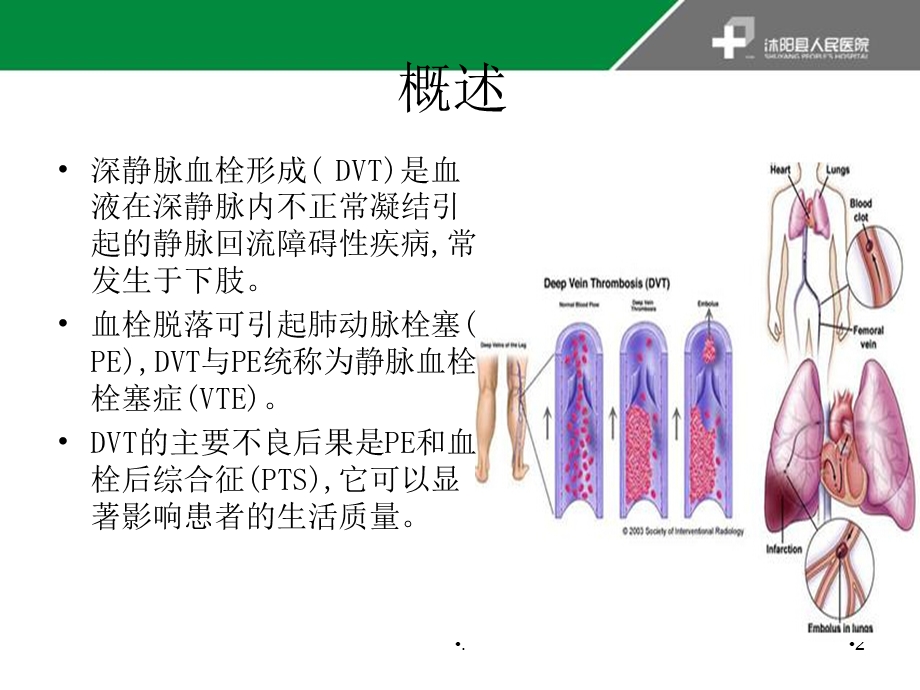 深静脉血栓指南课件.ppt_第2页