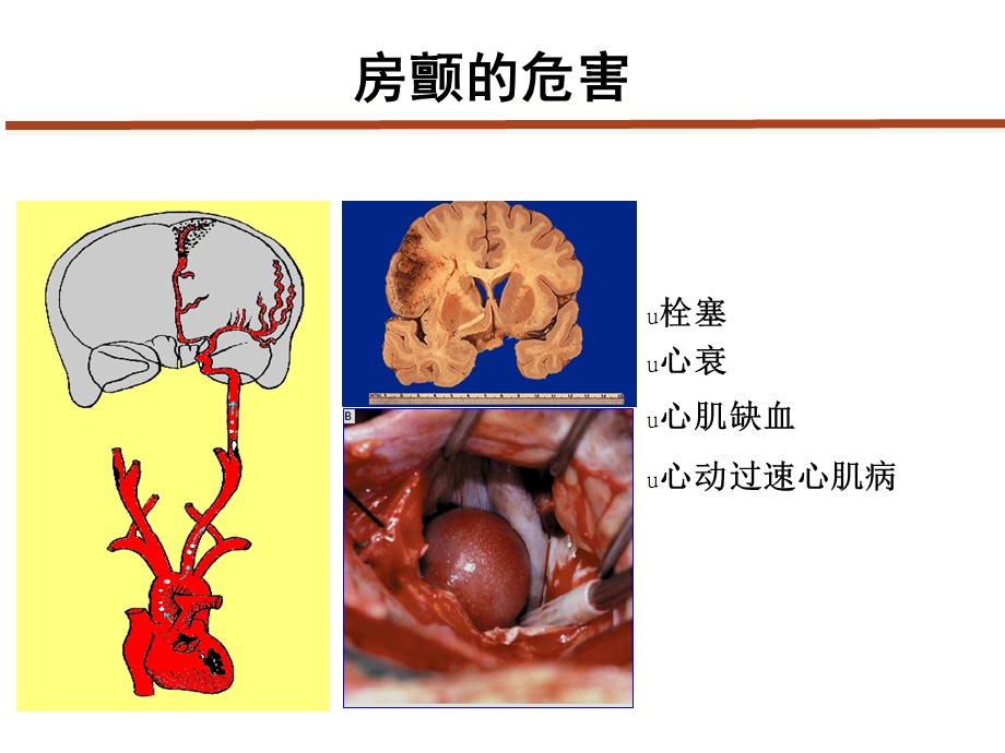 房颤抗凝的规范化治疗课件.ppt_第2页