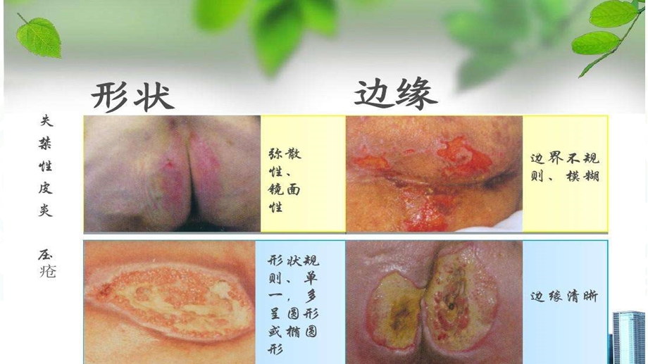 压力性损伤的预防与护理课件.ppt_第3页