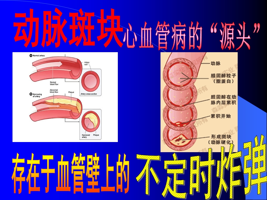 颈动脉斑块专题ppt课件.ppt_第1页