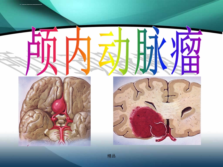 颅内动脉瘤介入术后的护理学习ppt课件.ppt_第1页