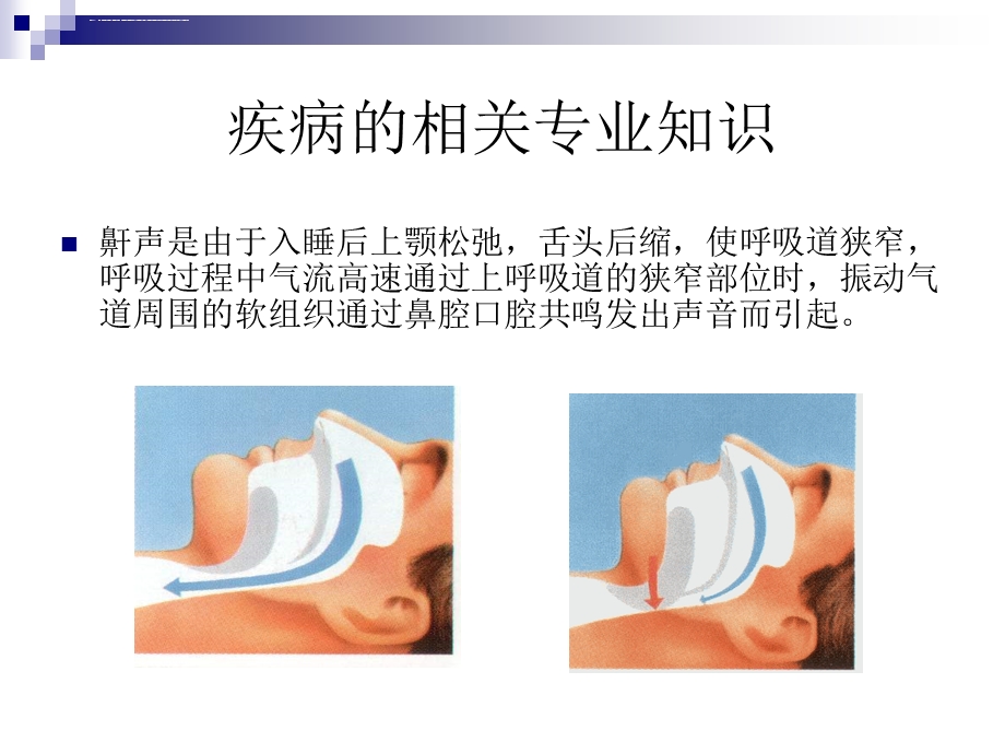 鼾症患者的护理查房ppt课件.ppt_第3页