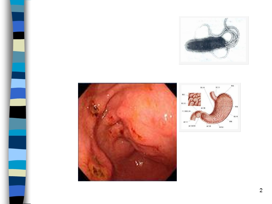 慢性胃炎课件.ppt_第2页