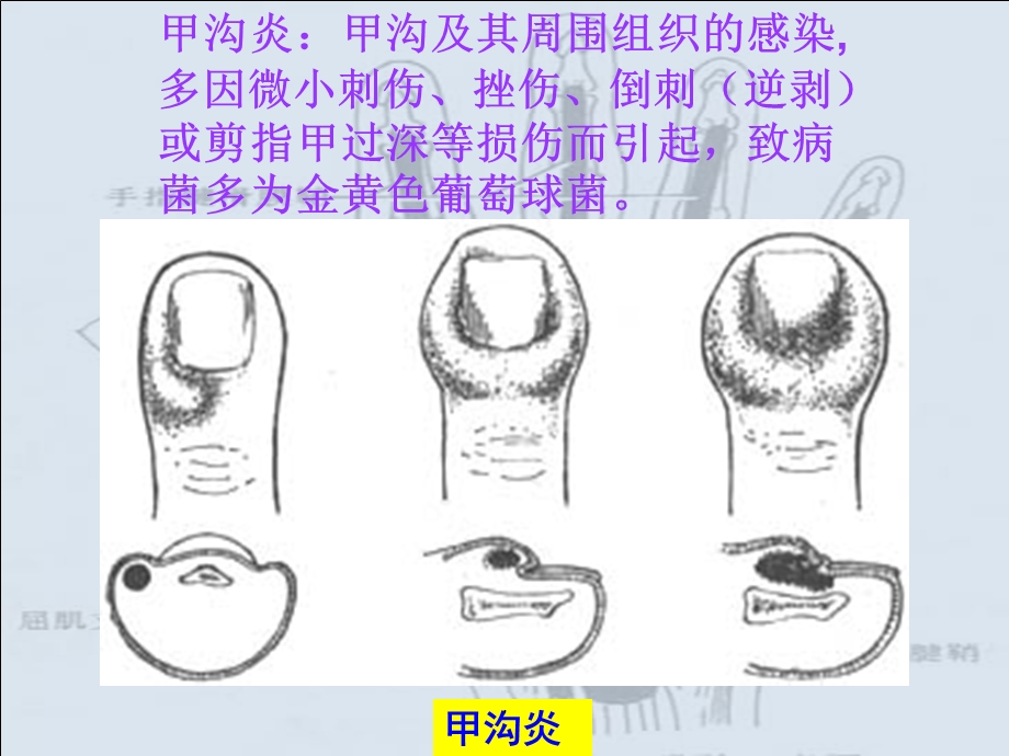 手部的化脓性感染课件.ppt_第2页