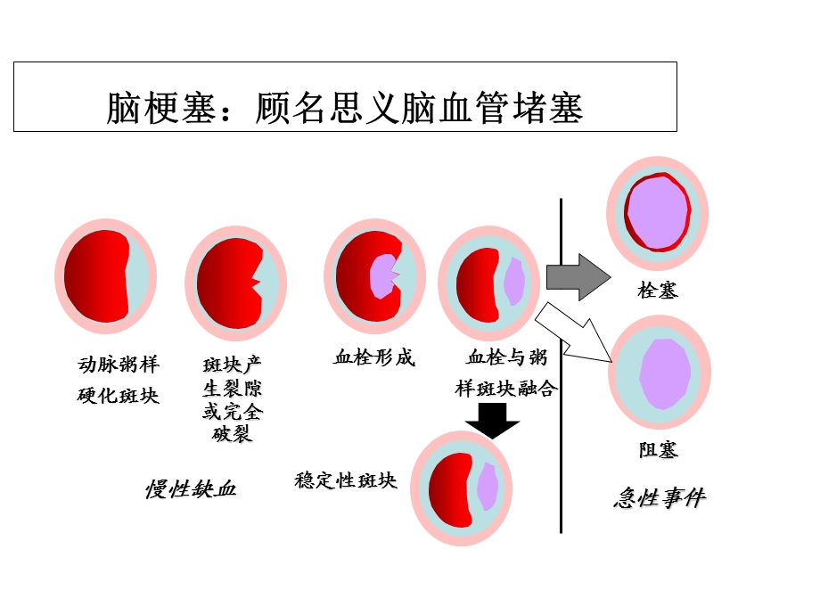 急性脑梗死rtPA溶栓治疗主题讲座ppt课件.ppt_第1页