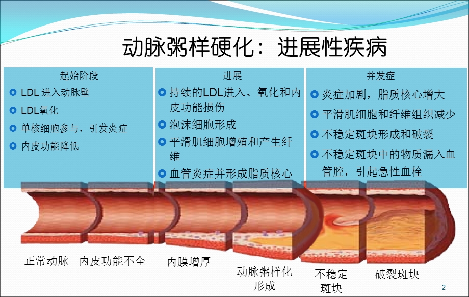 急性心肌梗死的抢救与护理课件.ppt_第2页