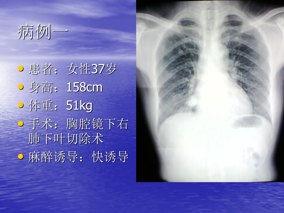 成人双腔气管导管管径的选择课件.ppt_第2页