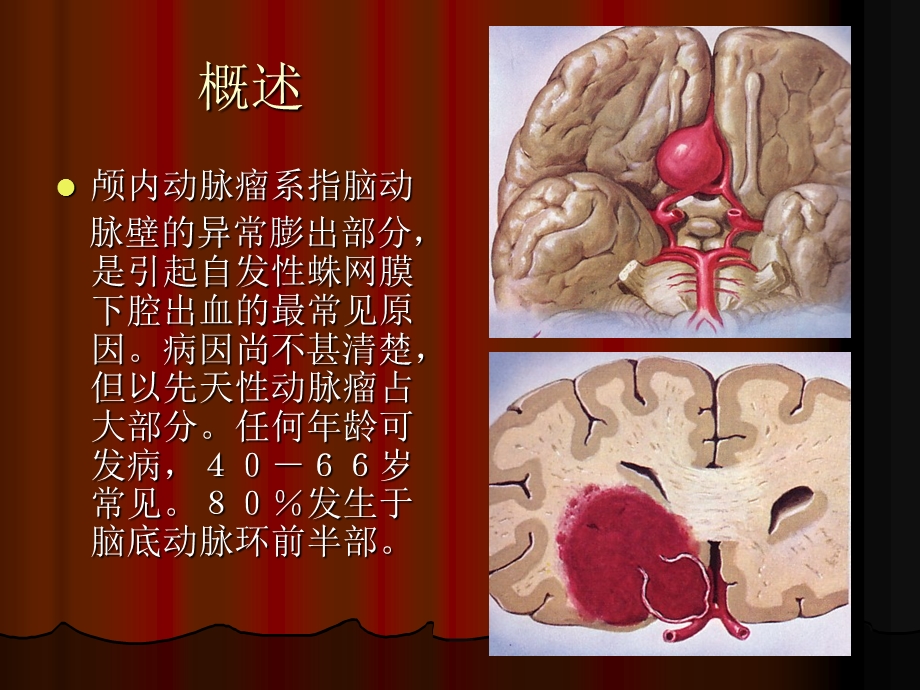 颅内动脉瘤ppt课件.ppt_第2页