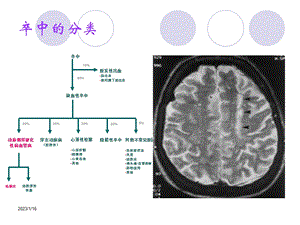 分水岭脑梗死和CT模板主题讲座ppt课件.ppt