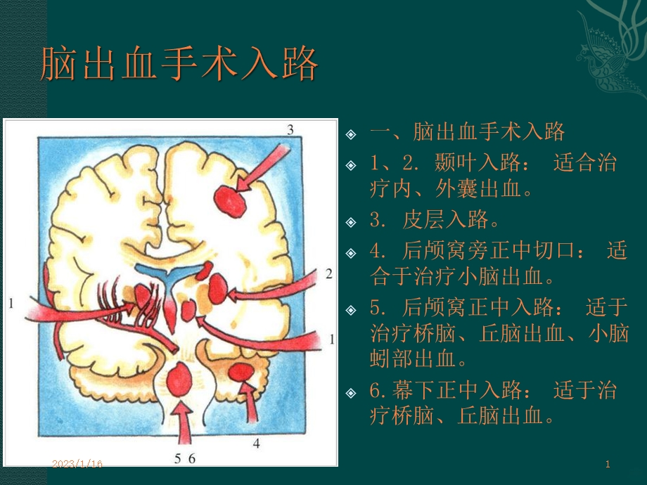 神经外科手术入路课件.ppt_第1页