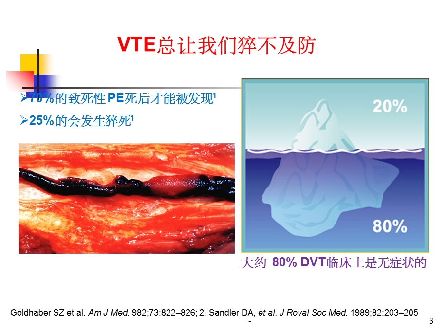 下肢深静脉血栓讲课课件.ppt_第3页