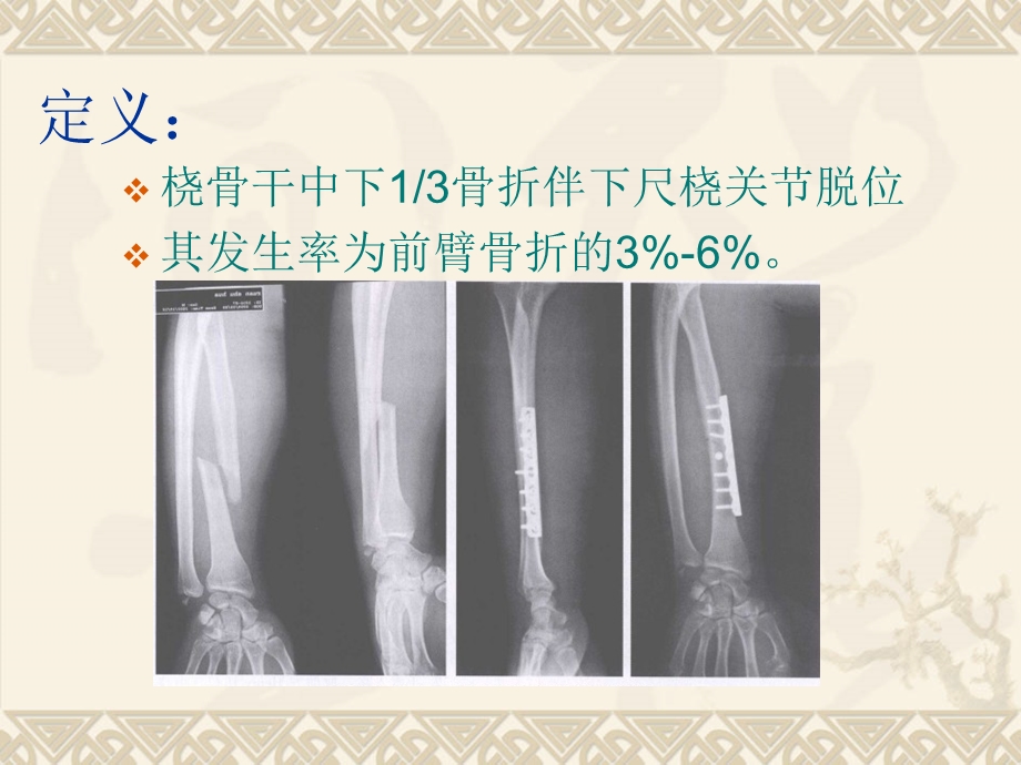 骨科ppt讲义盖氏骨折课件.ppt_第2页