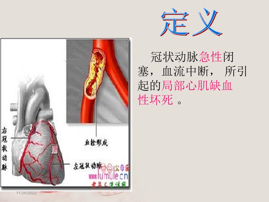 急性心肌梗死的溶栓护理查房医学课件.ppt_第3页