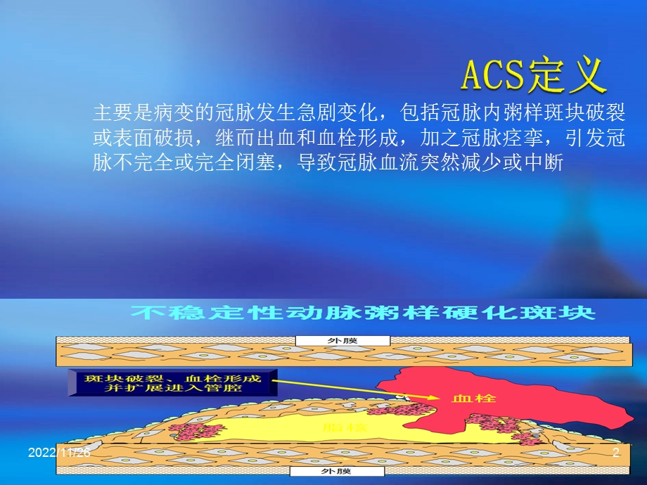 急性冠脉综合征护理查房课件.ppt_第2页