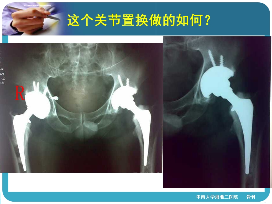 髋关节置换的X线评估ppt课件.ppt_第2页