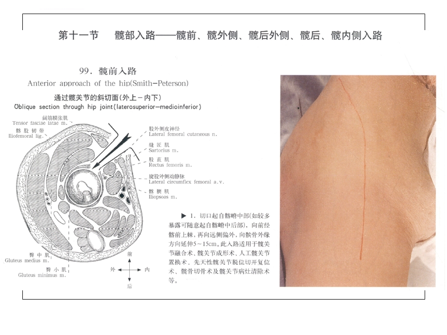 髋关节手术入路ppt课件.ppt_第2页