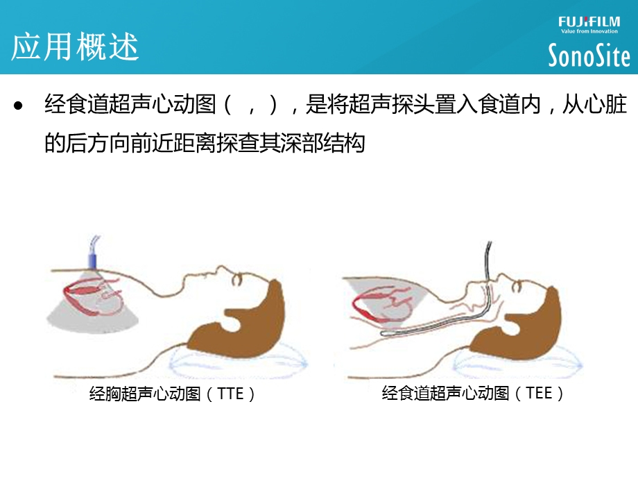 经食道超声心动图应用课件.pptx_第3页