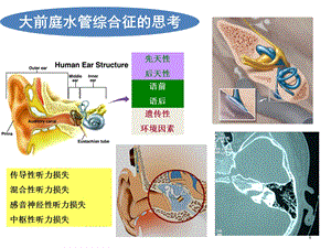 大前庭水管综合征的诊治课件.ppt