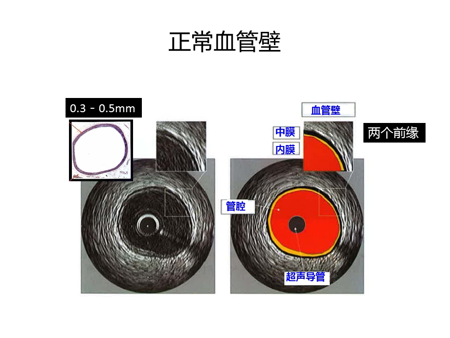 IVUS读图基本技巧课件.ppt_第2页