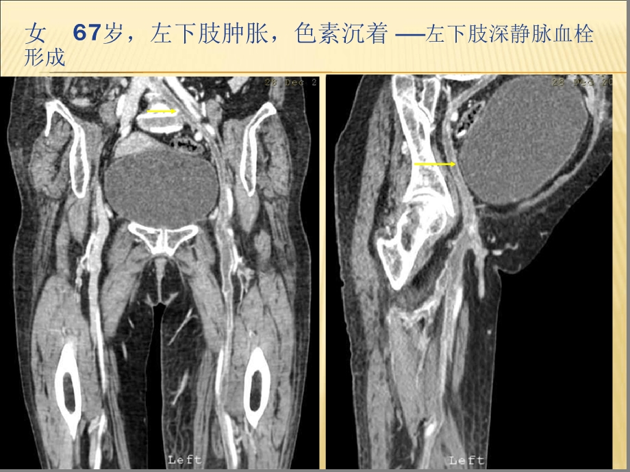 下肢CTV扫描方法课件.ppt_第3页