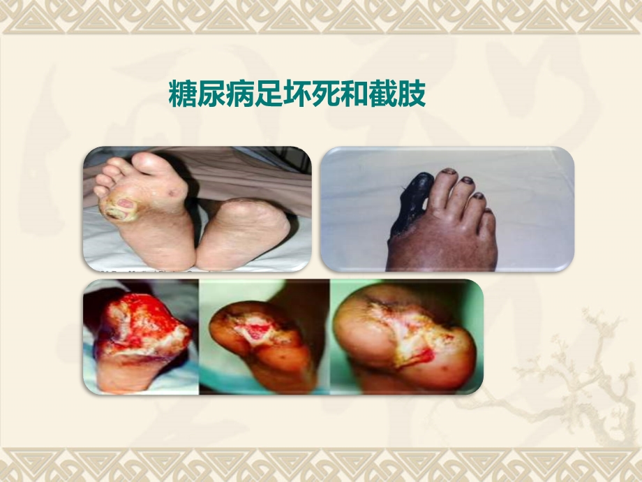 糖尿病健康教育糖尿病足课件.ppt_第3页