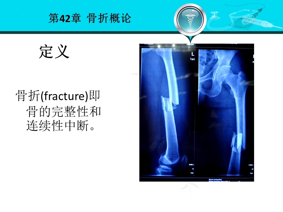 骨折概论 外科学第八版课件.ppt_第2页