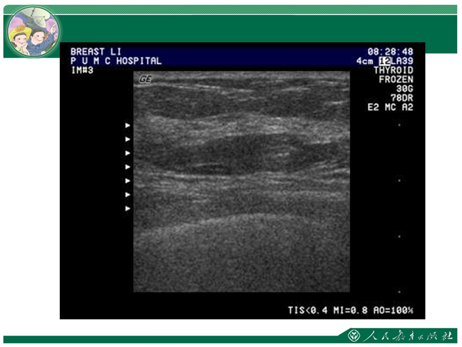 《乳腺超声》课件.ppt_第3页