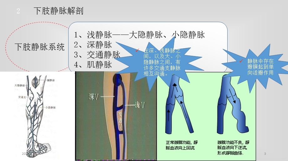 静脉曲张课件.ppt_第3页