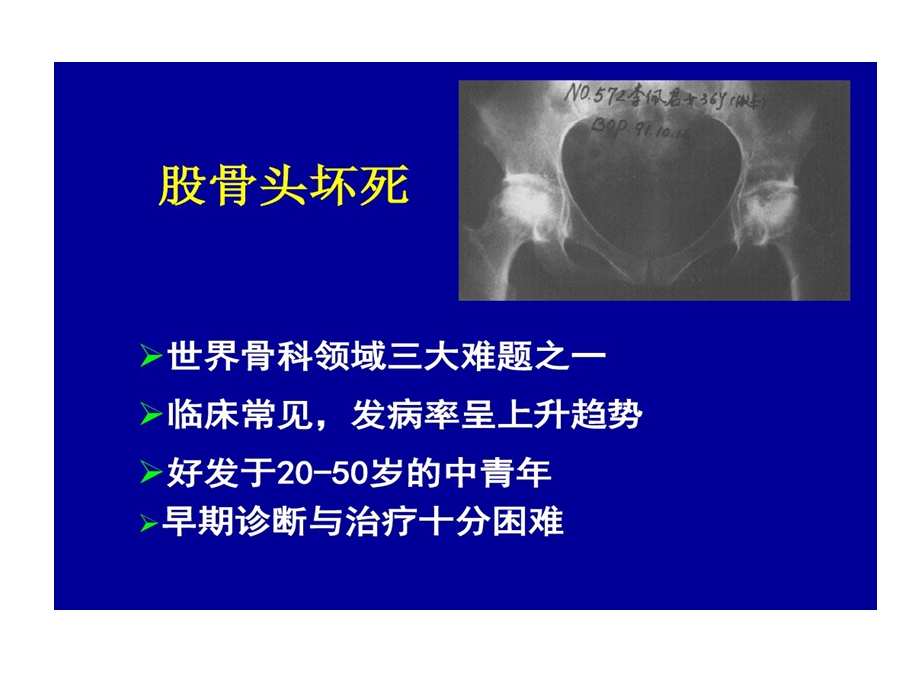 中西医结合治疗股骨头坏死临床的研究课件.ppt_第2页