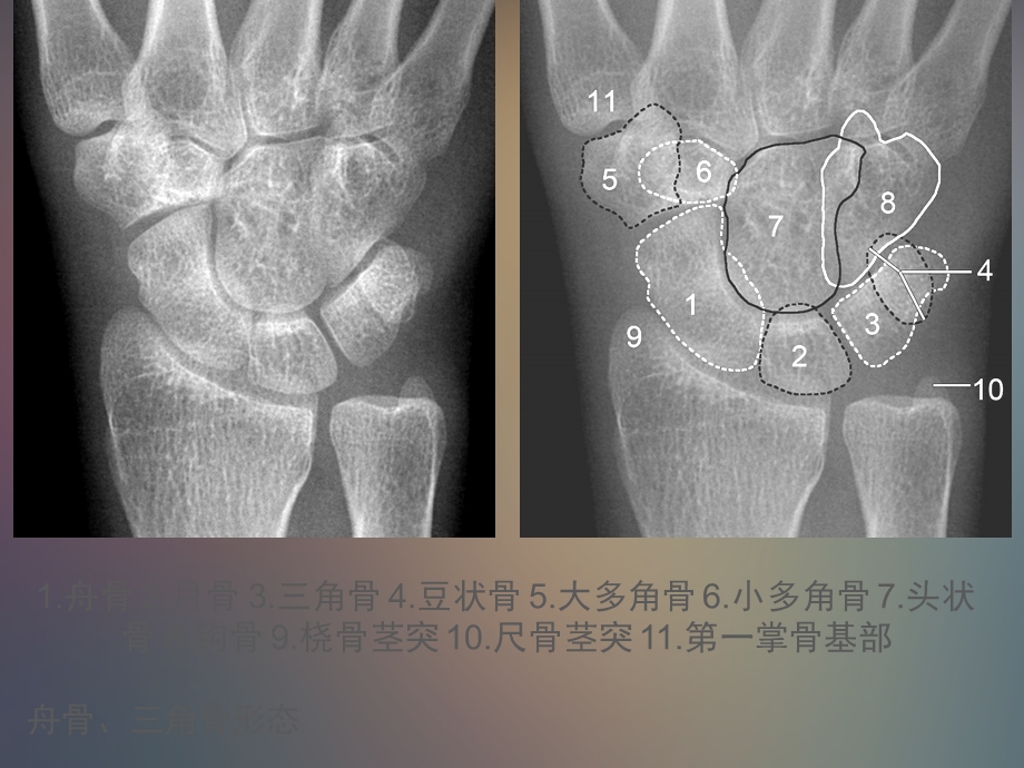 《腕关节解剖》课件.ppt_第3页