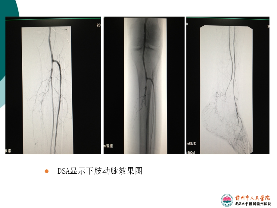 下肢血管超声规范检查与诊断课件.ppt_第2页